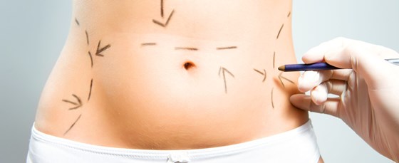 PureCryo Fat Freezing Inch Loss: Sussex Laser Lipo