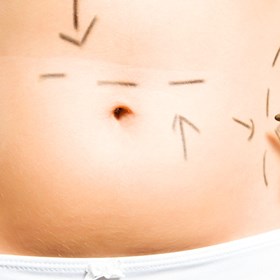 PureCryo Fat Freezing Inch Loss: Sussex Laser Lipo